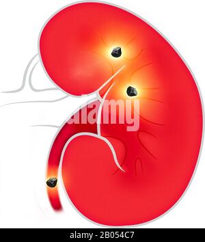 Vue du corps humain des reins. Les reins sont deux organes en forme de haricot trouvés chez les vertébrés. Pierres de rein Banque D'Images