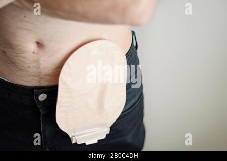 Vue avant sur le sac de colostomie attaché à l'homme patient, thème médical. Mise au point sélective sur le gros plan de la poche d'ostomie de couleur de peau. Traitement chirurgical du cancer du côlon Banque D'Images