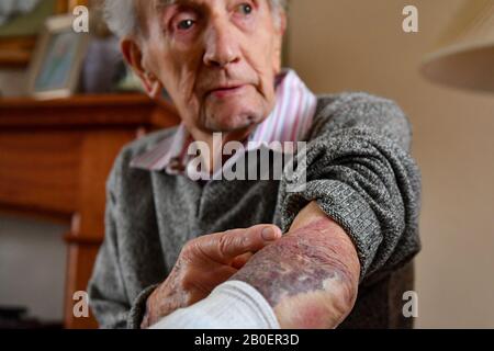 John Cox, 102 ans, montre les blessures qu'il a subies, après avoir combattu un conman cambrioleur qui a essayé d'accéder à sa maison à Lincoln, mardi. Banque D'Images