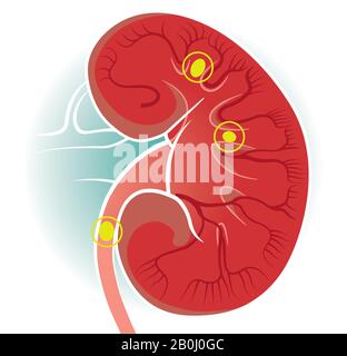 Vue du corps humain des reins. Les reins sont deux organes en forme de haricot trouvés chez les vertébrés. Pierres de rein Illustration de Vecteur