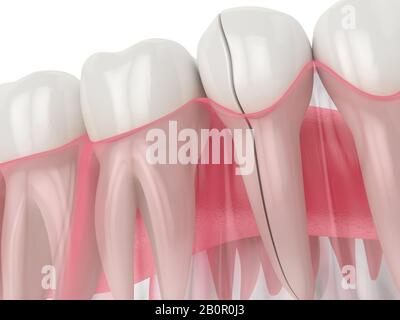 rendu tridimensionnel de la mâchoire avec dent fendue sur fond blanc. Types de dents cassées concept. Banque D'Images