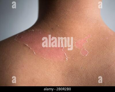 peau épluchant à l'arrière et à l'épaule de l'effet de coup de soleil sur le corps du jeune homme du bain de soleil en été. concept dangereux de coups de soleil Banque D'Images