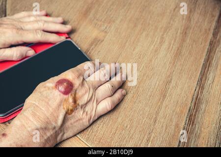 Les mains des femmes âgées avec un gros blister de traitement du cancer de la peau à la recherche de conseils médicaux en ligne - soins de santé et médecine / technologie concept i Banque D'Images