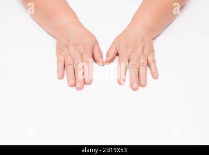 Sécher la peau avec des rides sur les mains d'une femme âgée, fond blanc, isoler. Fragilité des vaisseaux sanguins, carence en vitamine Banque D'Images