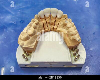 Milieu de travail de dentiste ou de technicien dentaire pour placer une prothèse partielle fixe dans la bouche Banque D'Images