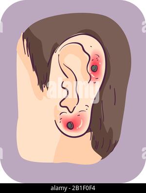 Illustration d'une oreille d'un homme avec perçage D'oreille Irritée Banque D'Images