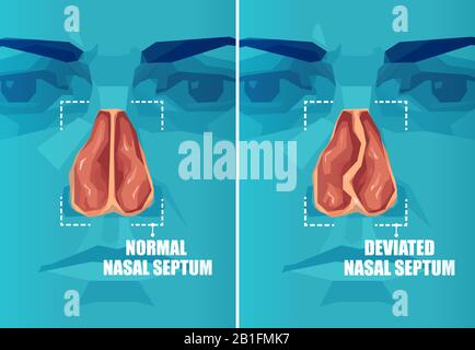 Section transversale vectorielle du visage humain avec septum nasal dévié et normal Illustration de Vecteur