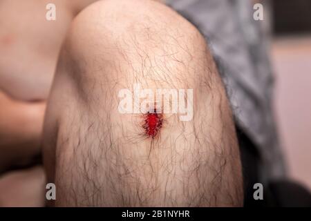 Gros plan de la plaie fraîche sur le genou de l'homme suite à un accident. Banque D'Images