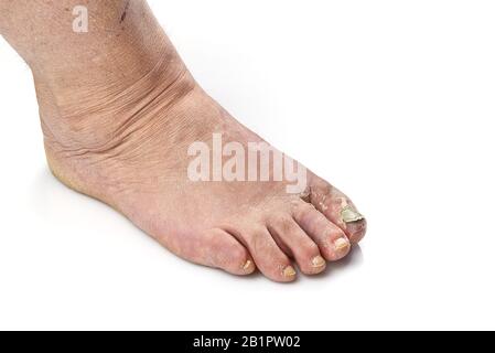 Ongle malade sur le pied. Champignon de la caille isolé sur blanc. Toenail douloureux, gros plan du champignon des ongles Banque D'Images