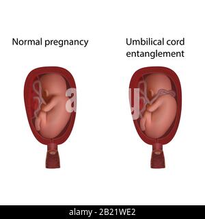 Enchevêtrement du cordon ombilical pendant la grossesse, illustration Banque D'Images