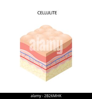 peau avec cellulite coupe transversale des couches de peau humaine structure skincare concept médical illustration vectorielle plate Illustration de Vecteur