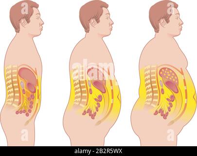 Illustration médicale des conséquences de l'obésité. Illustration de Vecteur