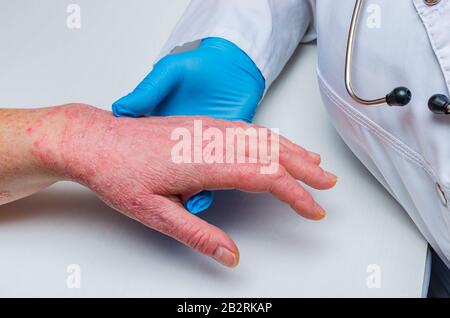 le médecin en gants examine la peau de la main d'un malade. Maladies chroniques de la peau - psoriasis, eczéma, dermatite. Banque D'Images