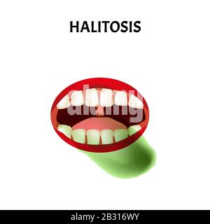 mauvaise respiration. Halose. La structure des dents et de la cavité buccale. Maladies des dents. Infographies. Illustration vectorielle sur un arrière-plan isolé. Illustration de Vecteur