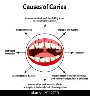 Causes des caries. Odeur de la bouche. Halose. La structure des dents et de la cavité buccale. Maladies des dents. Infographies. Vecteur Illustration de Vecteur