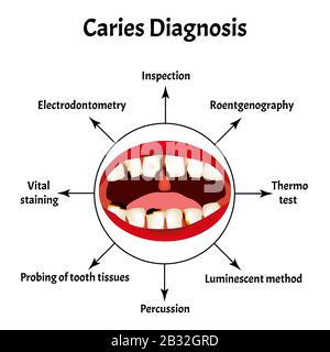 Diagnostic des caries. Mauvaise respiration. Halose. La structure des dents et de la cavité buccale avec des caries. Maladies des dents. Infographies. Vecteur Illustration de Vecteur