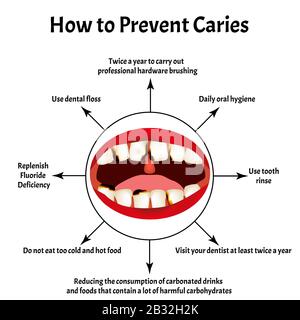 Comment éviter l'apparition de caries. Mauvaise respiration. Halose. La structure des dents et de la cavité buccale avec des caries. Maladies des dents Illustration de Vecteur