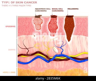 Tumeurs de la peau, mue et taches, section tridimensionnelle de la couche de peau. Trois types de cancer de la peau, carcinome épidermoïde, carcinome basocellulaire, mélanome Banque D'Images