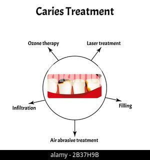 Traitement des caries. Mauvaise respiration. Halose. La structure des dents et de la cavité buccale avec des caries. Maladies des dents. Infographies. Vecteur Illustration de Vecteur