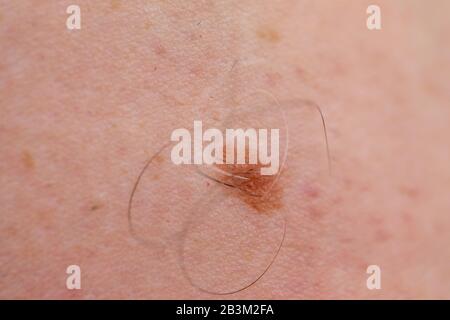 Close up photo de nevus brown dangereux sur la peau humaine - mélanome Banque D'Images