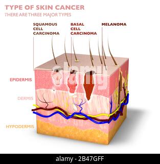 Tumeurs de la peau, mue et taches, section tridimensionnelle de la couche de peau. Trois types de cancer de la peau, carcinome épidermoïde, carcinome basocellulaire, mélanome Banque D'Images