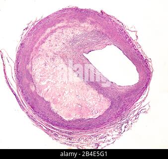 Section transversale d'une artère, montrant une plaque d'athéroma qui réduit drastiquement la lumière du vaisseau sanguin, située à droite. Banque D'Images