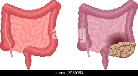 Anatomie des intestins humains forte en bonne santé et malsaine avec comparaison du cancer du côlon. Cavité abdominale digestive et excrétoire organe interne tumeur oncologique. Illustration du problème de digestion vectorielle Illustration de Vecteur