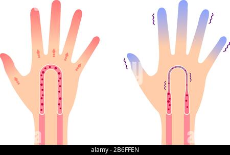 Illustration de comparaison de la main normale et de la main froide ( sensibilité au froid, bouts des doigts froids) / pas de texte Illustration de Vecteur