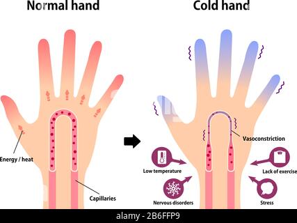 Illustration de comparaison de la main normale et de la main froide ( sensibilité au bout des doigts froid et froid) Illustration de Vecteur