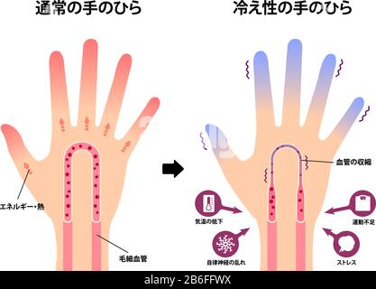 Illustration de comparaison de la main normale et de la main froide ( sensibilité au froid, bouts des doigts froids) / Japonais Illustration de Vecteur
