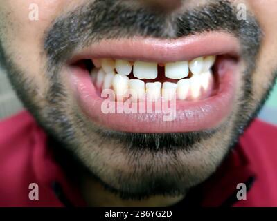 Un homme avec une barbe montre ses dents, il a un écart de dent. Banque D'Images