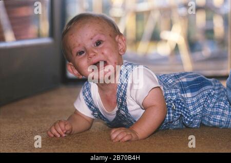 Austin Texas USA, 1997: Pleurs bébé de sept mois-garçon avec la varicelle. M. ©Bob Daemmrich Banque D'Images