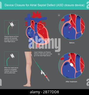 Dispositifs De Fermeture Pour Défaut Septal Auriculaire. Expliquer le traitement l'anomalie du défaut septal d'atrial (ASD) par l'utilisation de dispositifs médicaux fermeture du cœur de la paroi de Ri Illustration de Vecteur