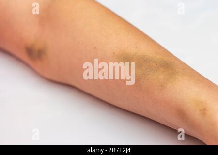 La main féminine a été ecchymosée après un abus chez les hommes. Banque D'Images