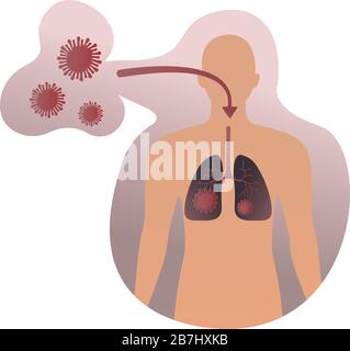 Maladie infectieuse. Kit d'infographie médicale avec icônes et autres éléments. 2019-nCoV corona virus concept avec virus entre dans les poumons humains sur blanc Illustration de Vecteur