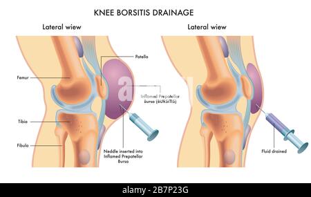 Illustration médicale marquée montrant la procédure de drainage de la bursite du genou. Banque D'Images