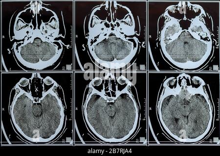IRM du cerveau. Examen IRM du cerveau ou de la neurologie des rayons X de la tête humaine du crâne. Tomographie par résonance magnétique. Mise au point sélective. Banque D'Images