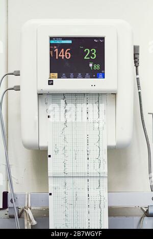 Gros plan d'un moniteur fœtal ou d'un test de non-stress pour l'impression de battements cardiaques, d'électrocardiographes et de contractions utérines de la mère dans la salle de travail et d'accouchement Banque D'Images