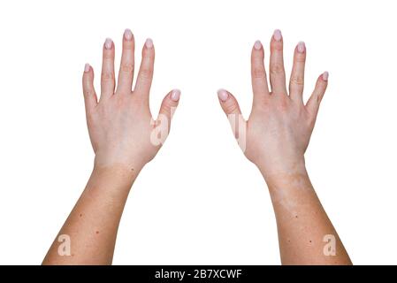 Taches de la maladie de vitiligo sur les parties extérieures de la main d'une jeune femme caucasienne, isolée sur un fond blanc avec un chemin d'écrêtage. Banque D'Images