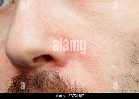 Partie du visage avec le nez d'un homme blanc adulte avec une peau sèche et boisée. Problèmes de peau et maladies. Banque D'Images