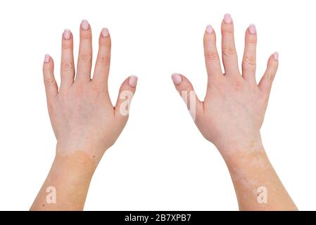 Taches de la maladie de vitiligo sur les parties extérieures de la main d'une jeune femme caucasienne, isolée sur un fond blanc avec un chemin d'écrêtage. Banque D'Images