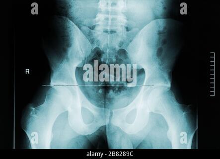 Image radiographique de la vue arrière du bassin masculin, du col fémoral et des vertèbres lombaire. Imagerie médicale et anatomique humaine. Banque D'Images