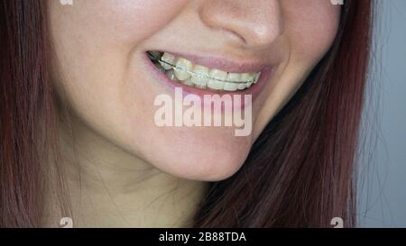 Portrait de jeune femme souriante portant des accolades dentaires - gros plan. Banque D'Images