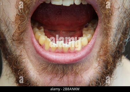 Un homme blanc avec une barbe et une moustache montre ses dents et sa bouche ouverte. Gros plan du visage, dents jaunâtres, joues et menton. Médecine, santé bucco-dentaire. Banque D'Images