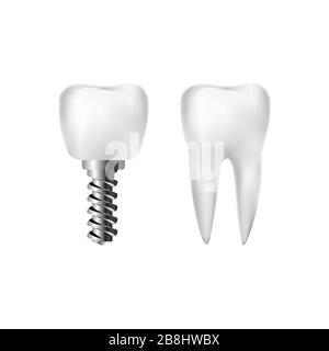 Dent blanche et implant réalistes avec vis. Dentisterie et soins dentaires. Vecteur Illustration de Vecteur