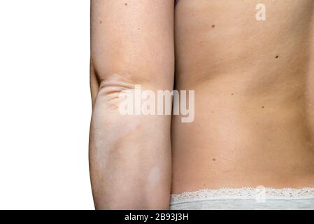 Taches de la maladie de vitiligo sur les coudes d'une jeune femme caucasienne, isolée sur un fond blanc avec un chemin d'écrêtage. Banque D'Images