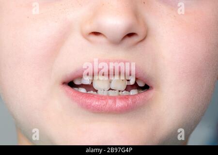 Médecine dentaire et soins de santé. Petit garçon patient bouche ouverte montrant caries dents décroissance Banque D'Images