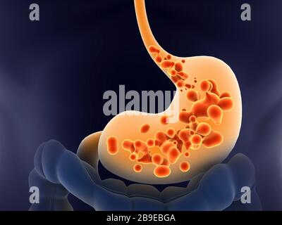 Illustration médicale du reflux acide dans l'estomac humain. Banque D'Images