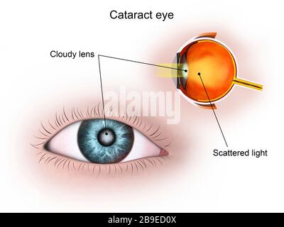 Illustration médicale d'une cataracte dans l'œil humain. Banque D'Images