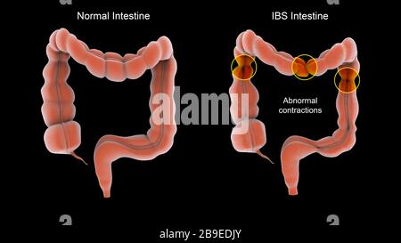 Contractions normales et anormales associées au syndrome de l'intestin irritable dans les intestins humains. Banque D'Images